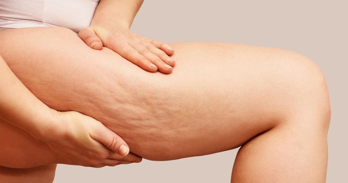 cellulite-an-den-oberschenkeln-creme-gegen-cellulite