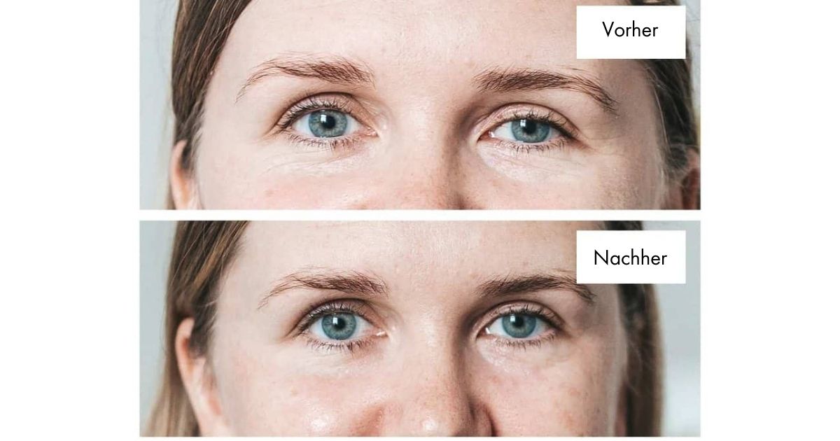 nano-eye-lift-vorher-nachher