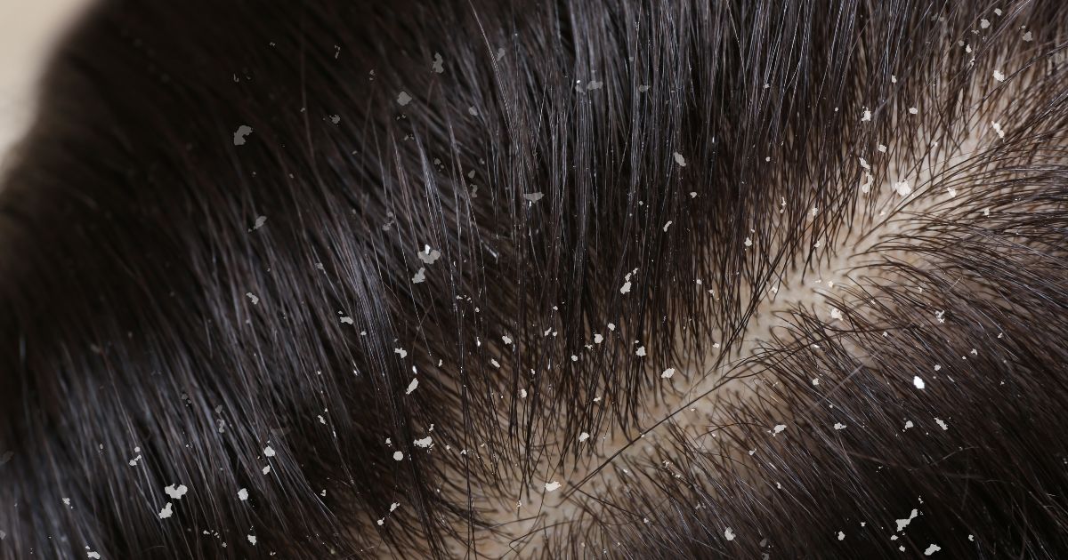 seborrhoische-dermatitis