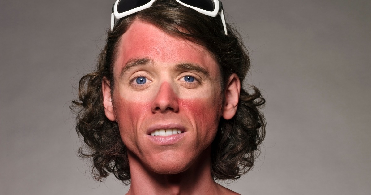 sonnenbrand