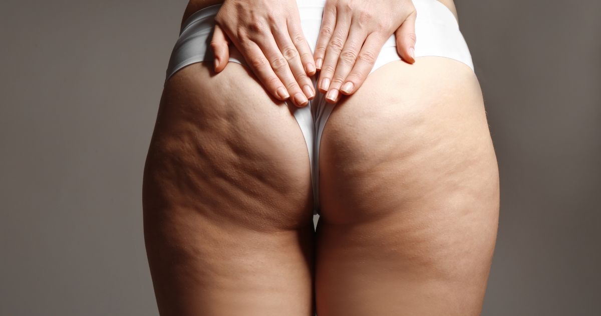 was-hilft-gegen-cellulite