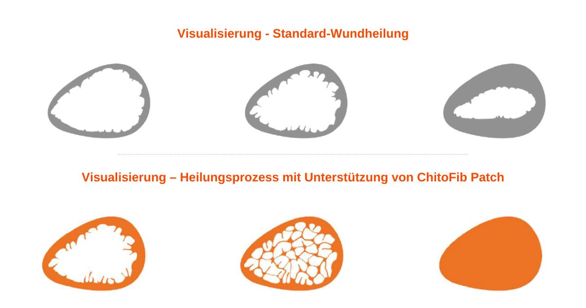 wundheilung-chitofib-chitosan
