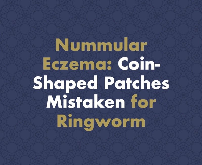Nummular (Discoid) Eczema: Coin-Shaped Patches That Get Mistaken for Ringworm