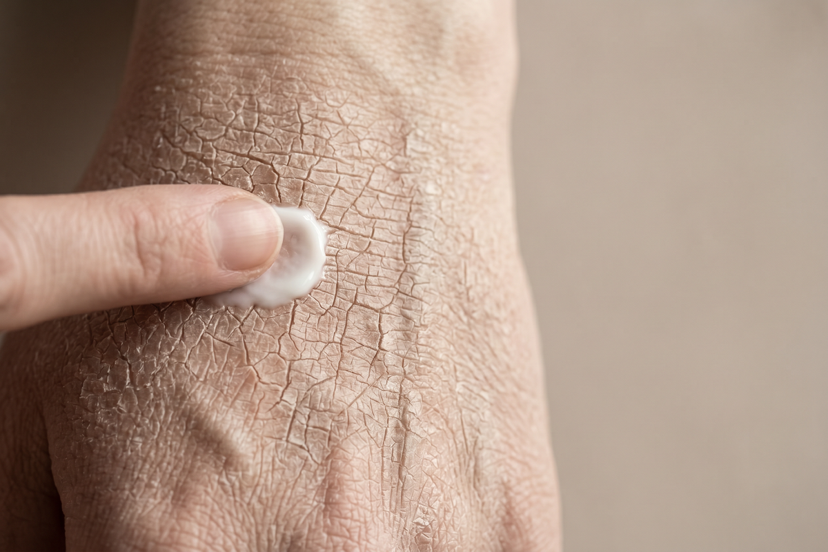 Asteatotic eczema – very dry, cracked skin resembling a dried riverbed