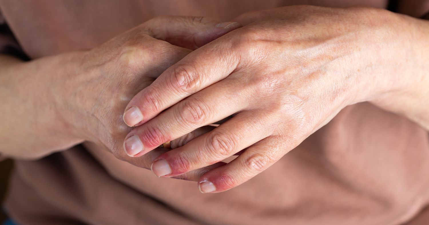 atopic-eczema-diet
