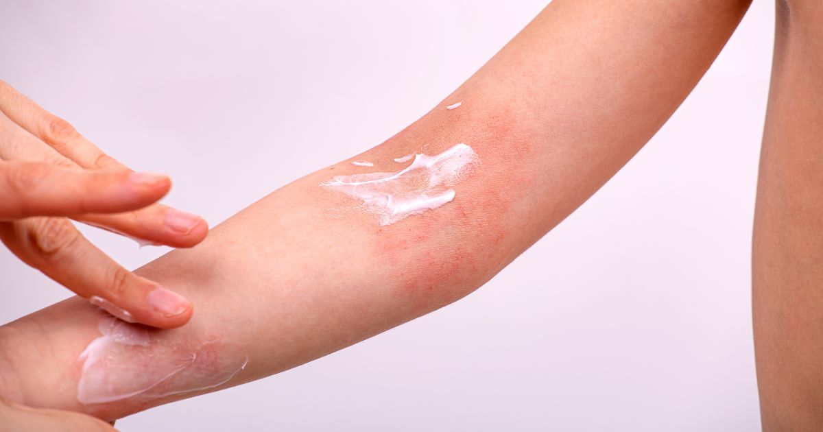 atopic-eczema-in-children-2