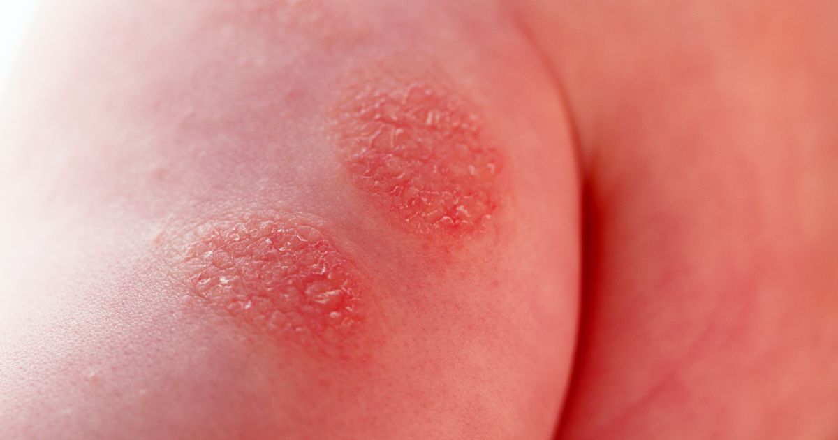 atopic-eczema-in-children