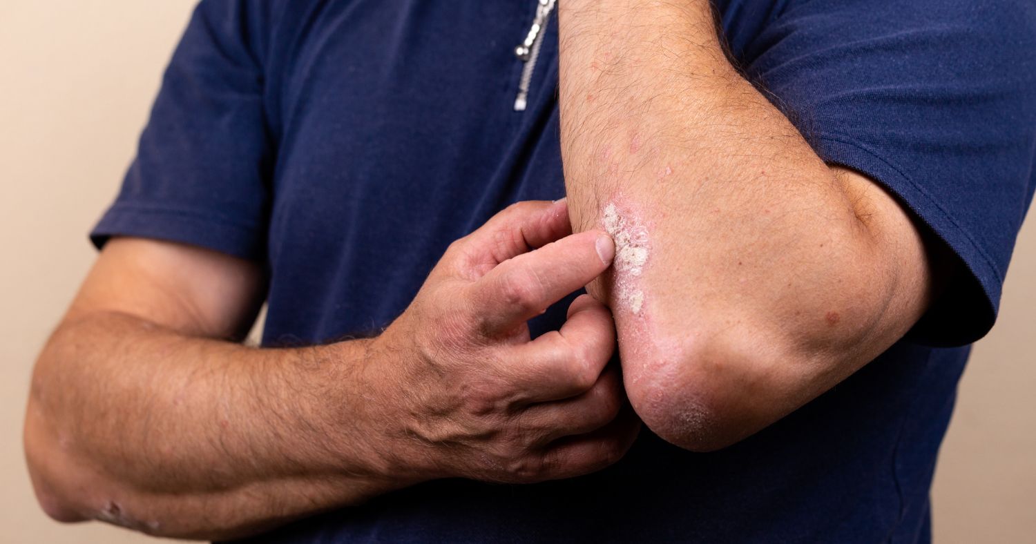 atopic-eczema-on-elbow