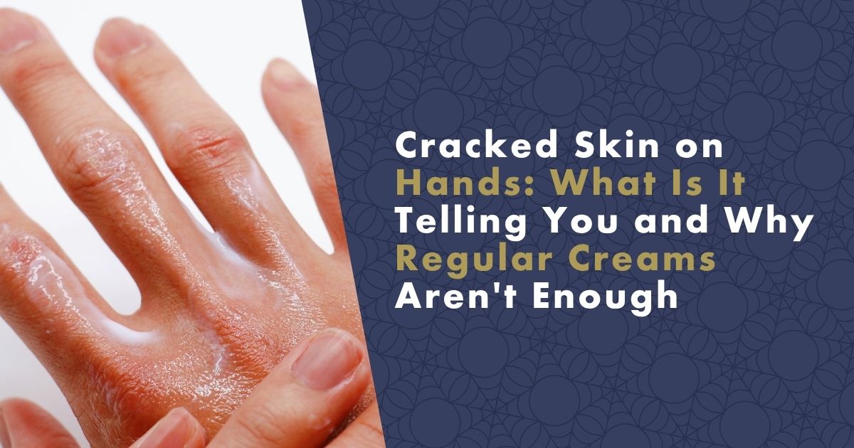 cracked-skin-on-hands-fb