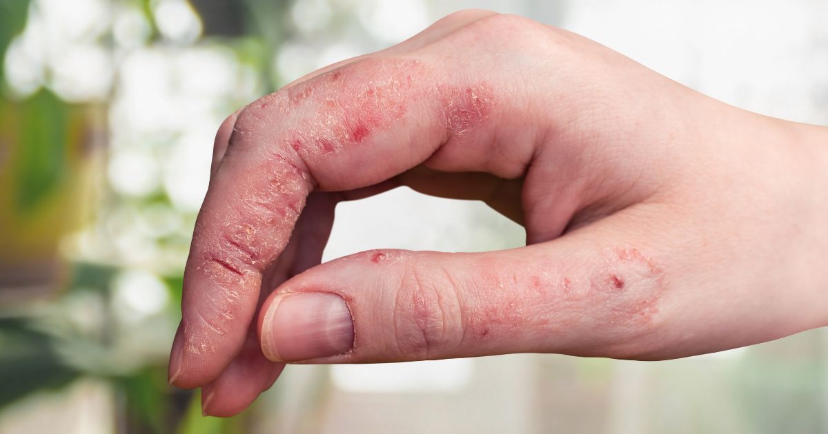 cracked-skin-on-hands