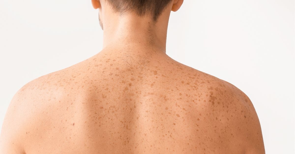 dark-brown-spots-on-skin