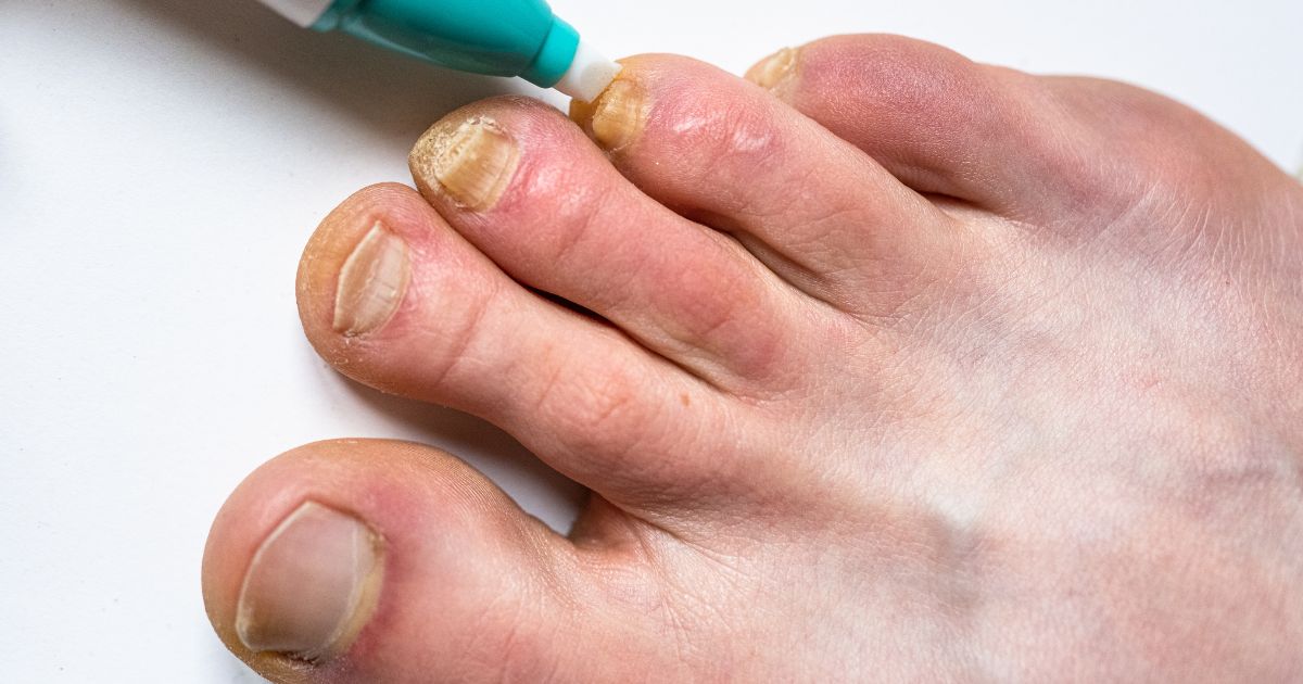 diseased-fingernails-and-toenails