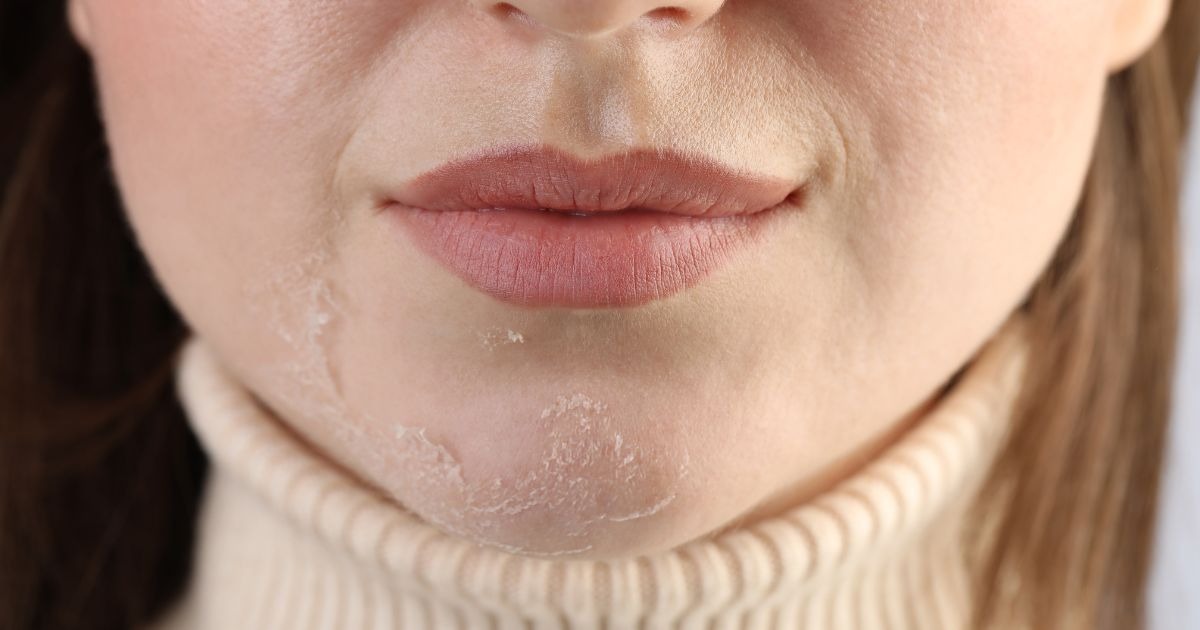 extremely-dry-skin