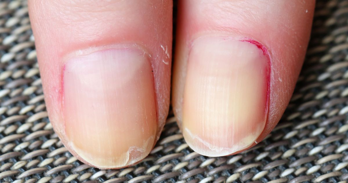 frayed-nails-home-remedies