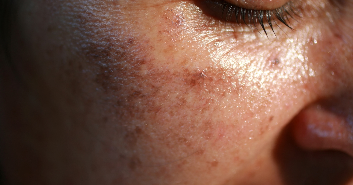 freckles