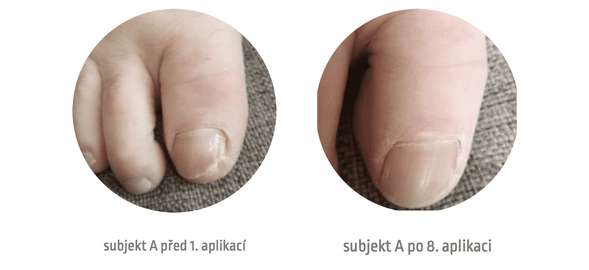 Prevention and Treatment of Toenail Fungus