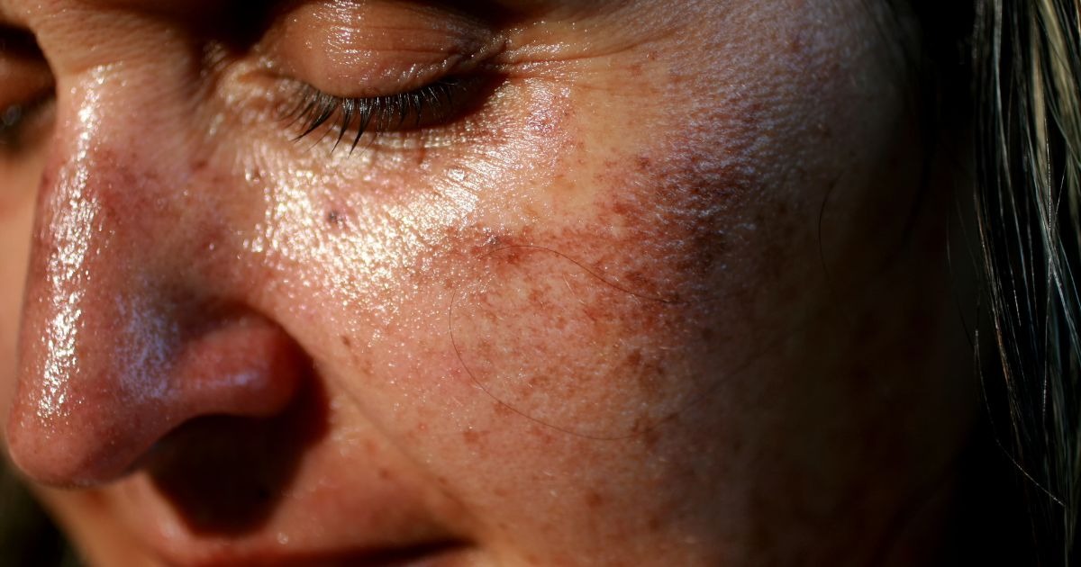 pigment-spots