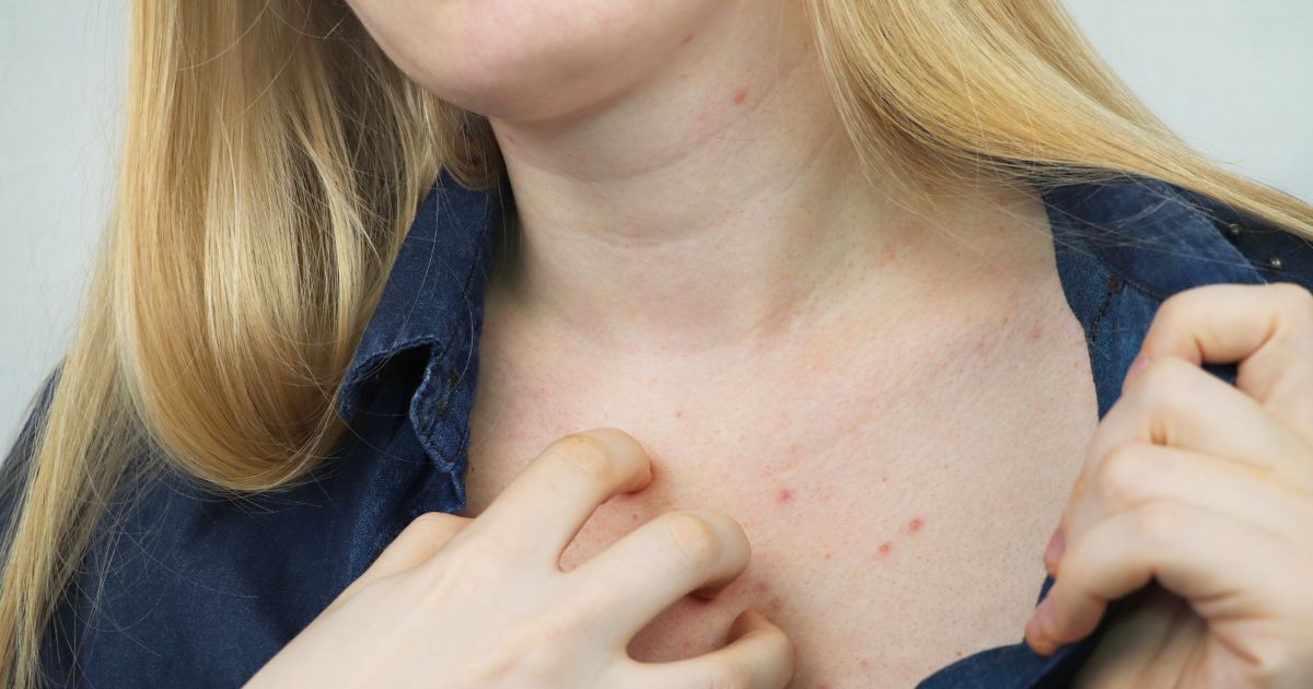 scabies-itchy-skin-rash
