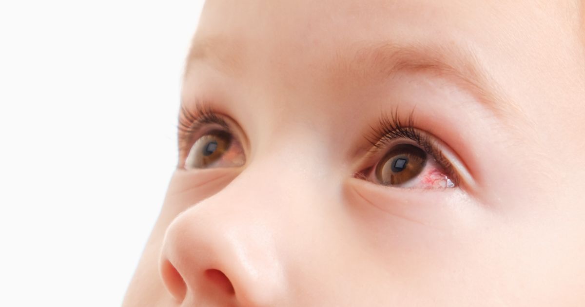 what-causes-conjunctivitis-in-children