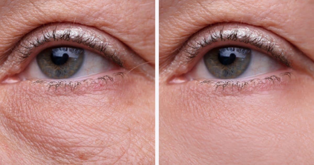 wrinkle-reduction-after-application