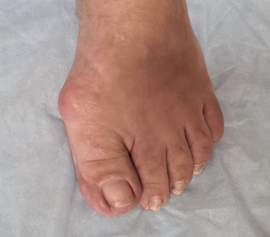 Proč vzniká Hallux valgus a jak ho zpomalit?