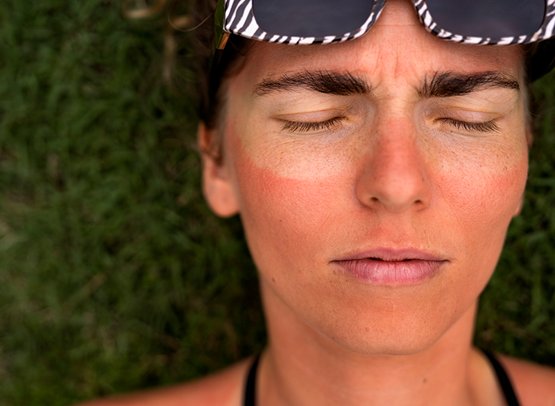 První pomoc při úpalu a úžehu: Co dělat krok za krokem