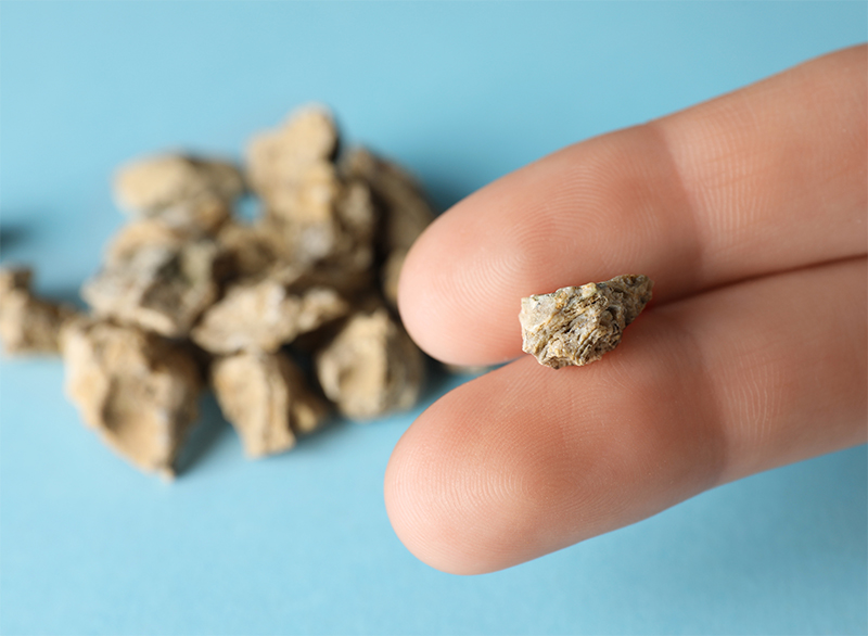 Kamica nerkowa pod lupą: jak powstaje, jak ją rozpoznać i jak jej zapobiegać?