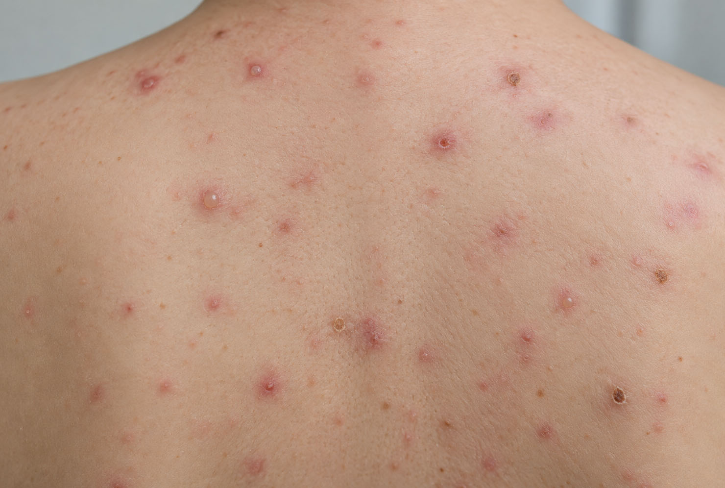 nestovice-impetigo-priznaky-lecba-2