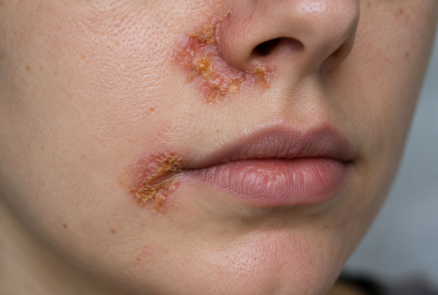 nestovice-impetigo-priznaky-lecba-3