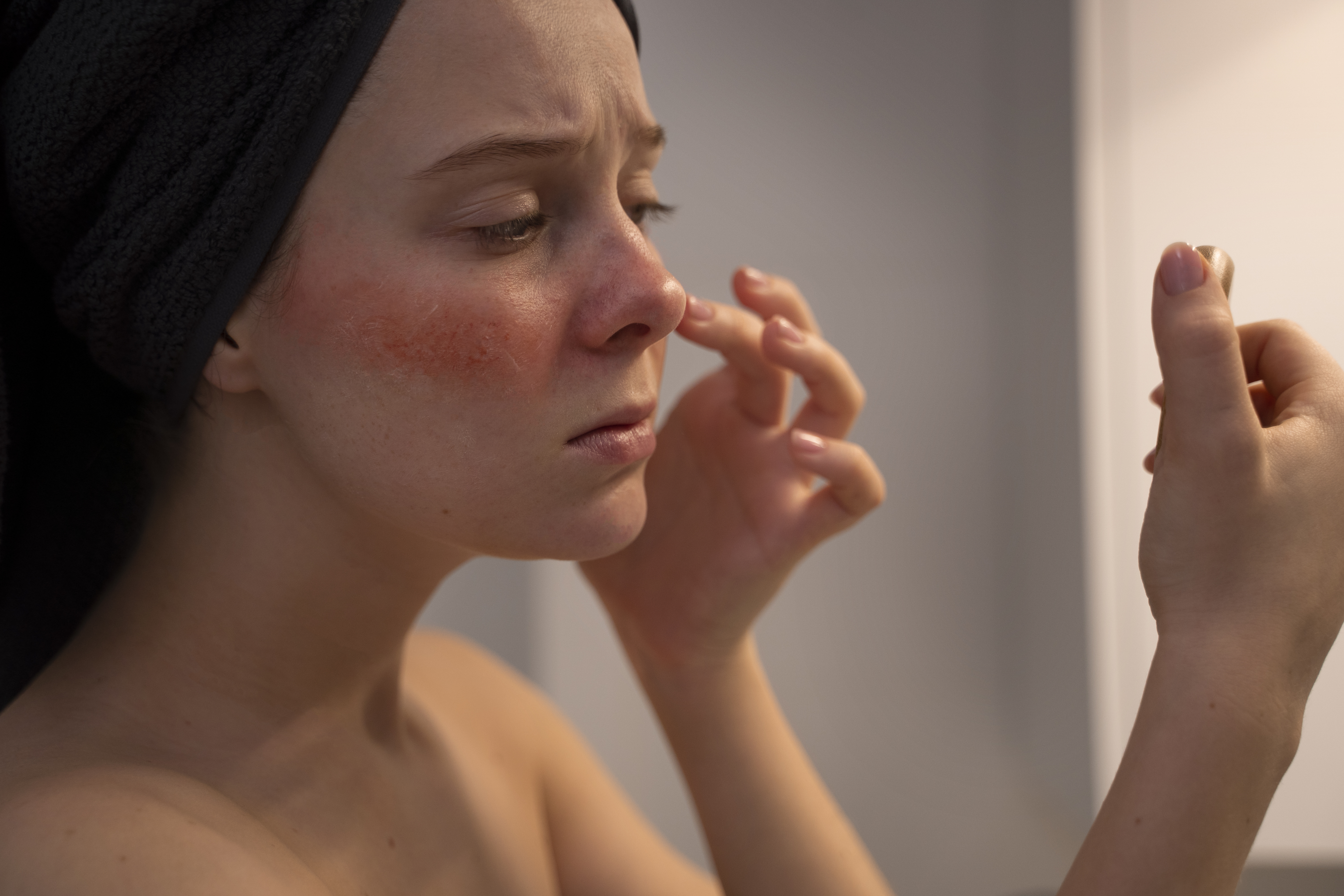 Rosacea liečba – Ako získať späť svoju bezchybnú pleť