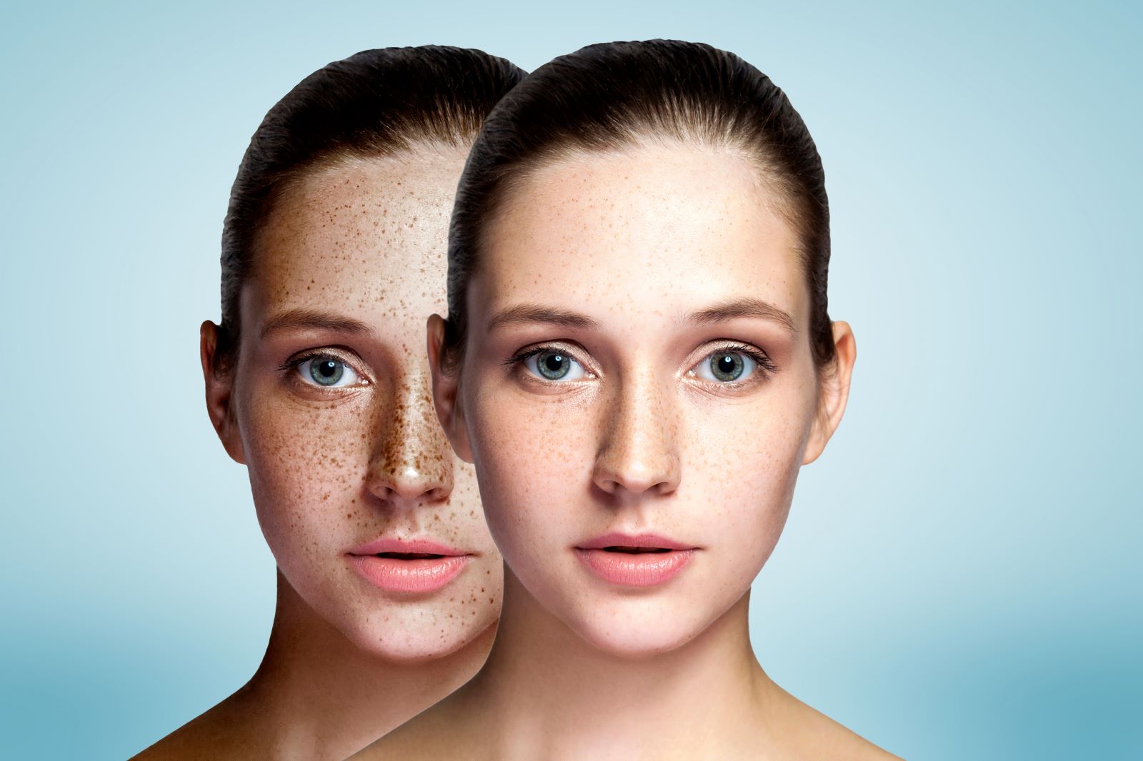 Hiperpigmentáció – hogyan lehet a leghatékonyabban küzdeni ellene