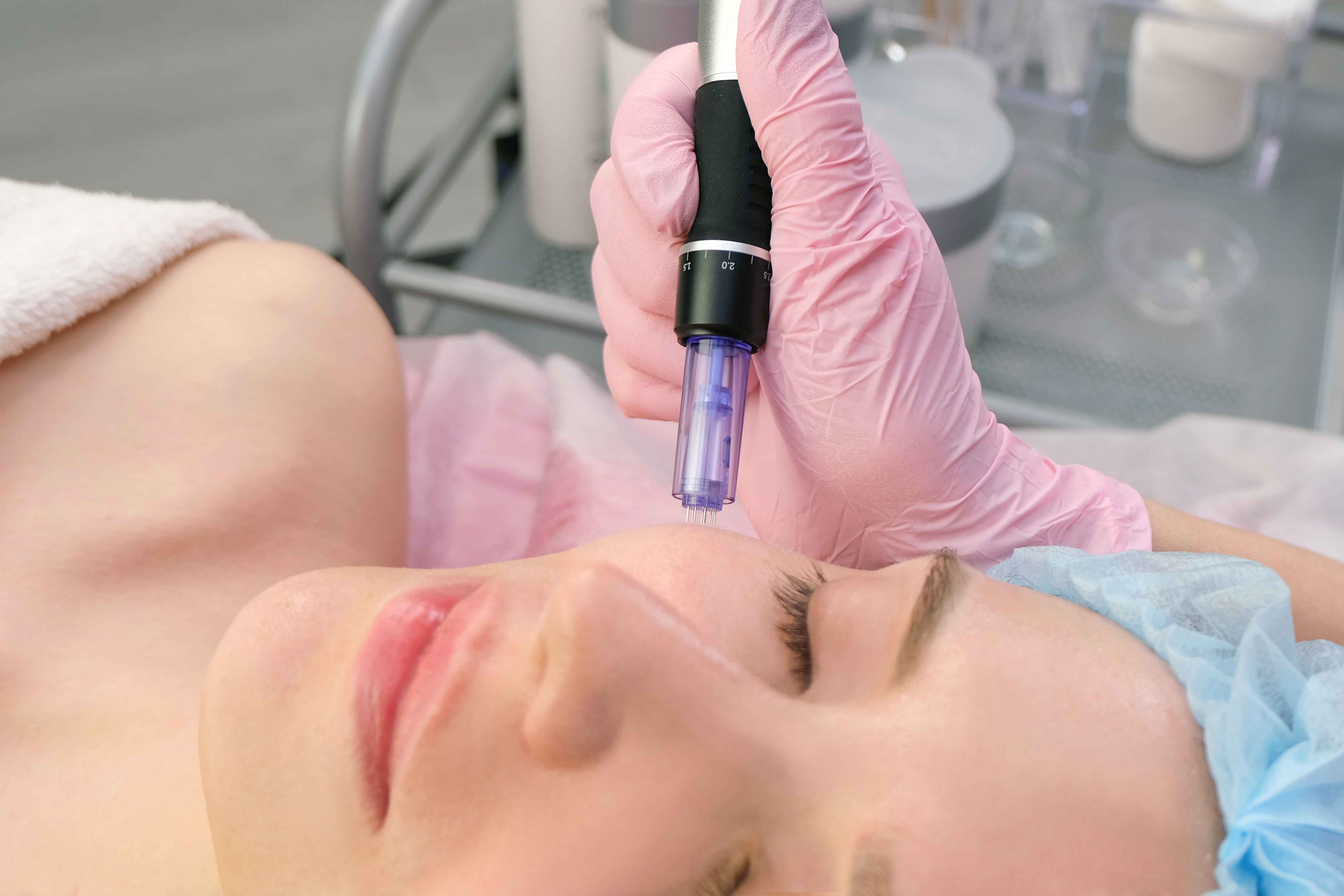 microneedling