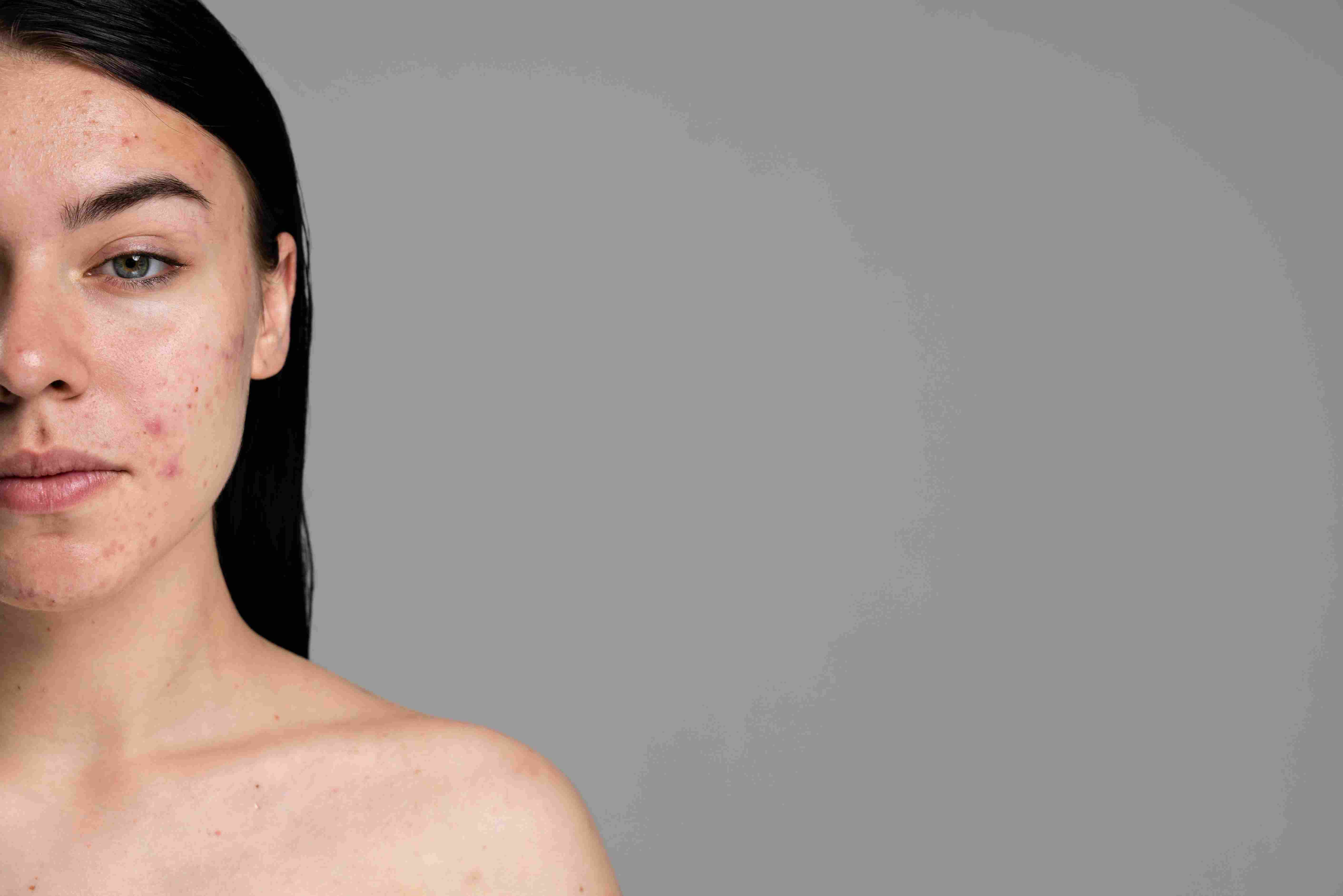 Blizny potrądzikowe - nie pozwól, by powodowały niską samoocenę