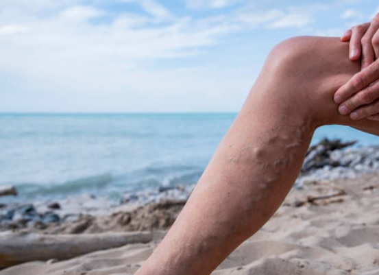 Prírodnou cestou proti kŕčovým žilám