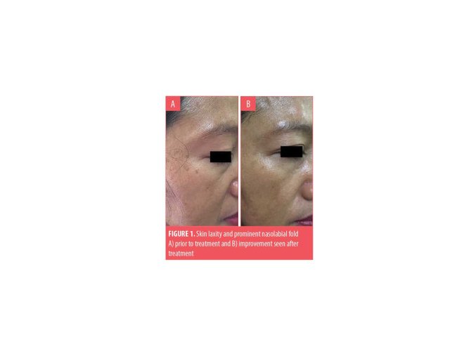 epidermal growth factor egf recombinant