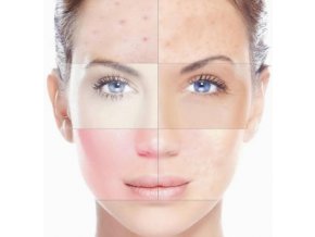 rosacea