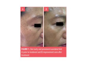 epidermal growth factor egf recombinant