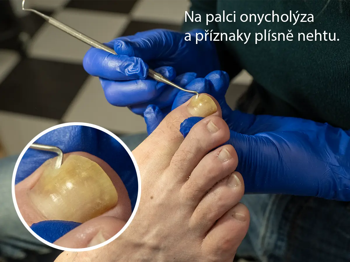 Na palci onycholýza a příznaky plísně nehtu