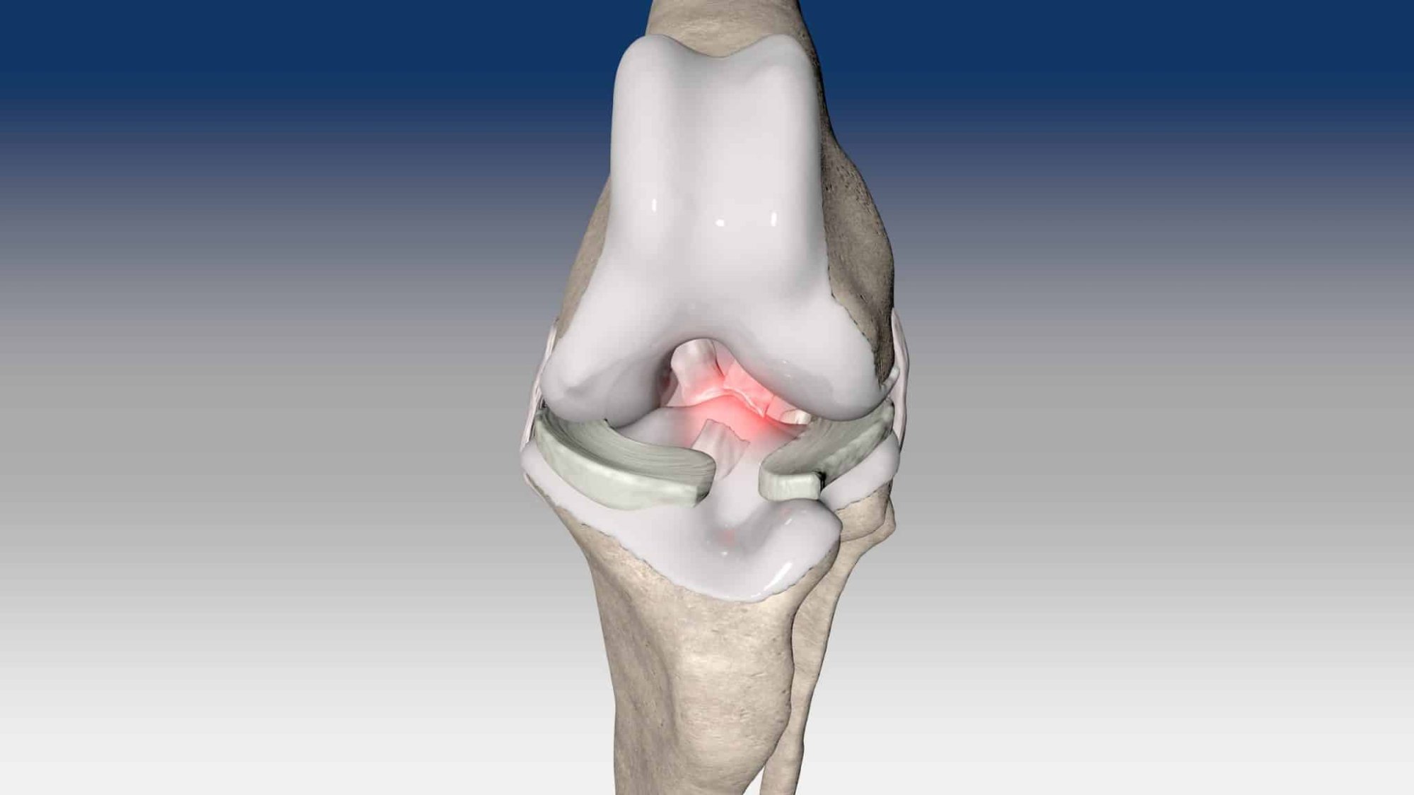 Intra-articular reconstruction of cranial cruciate ligament
