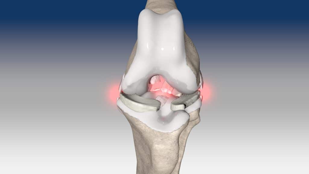 Global Stifle Disruption - intra articular repair