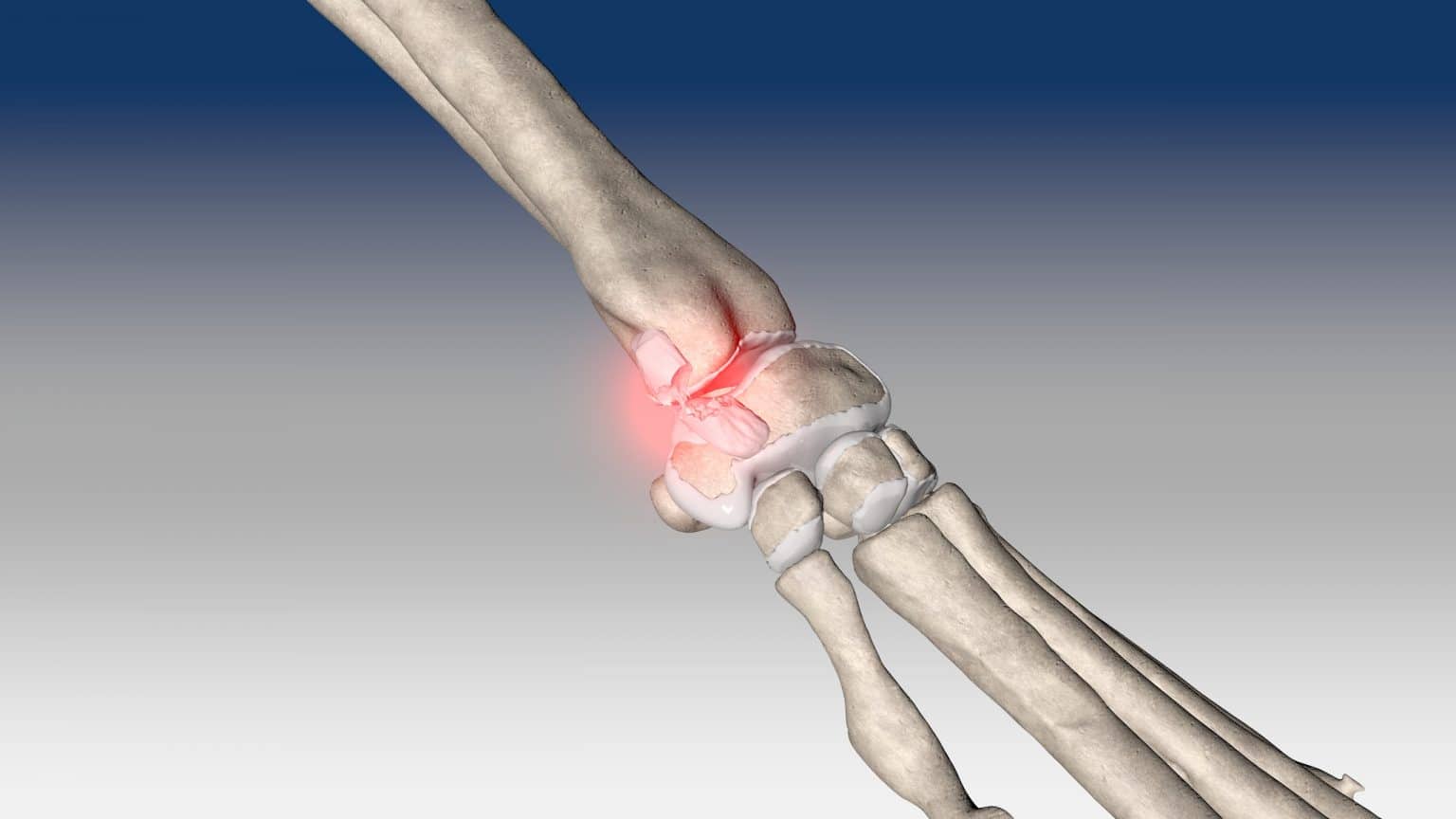 Carpal medial collateral ligament reconstruction