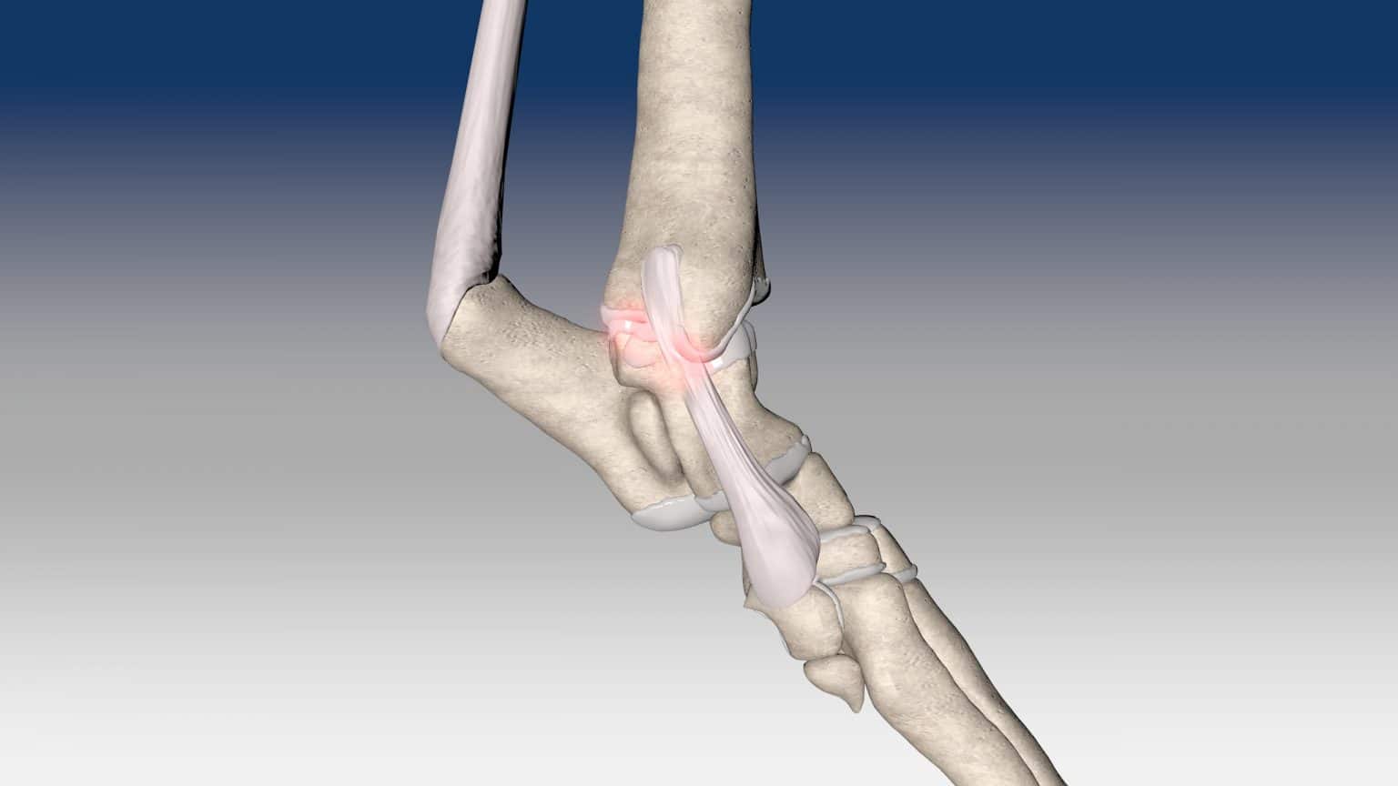 Reconstruction of tarsal medial collateral ligament
