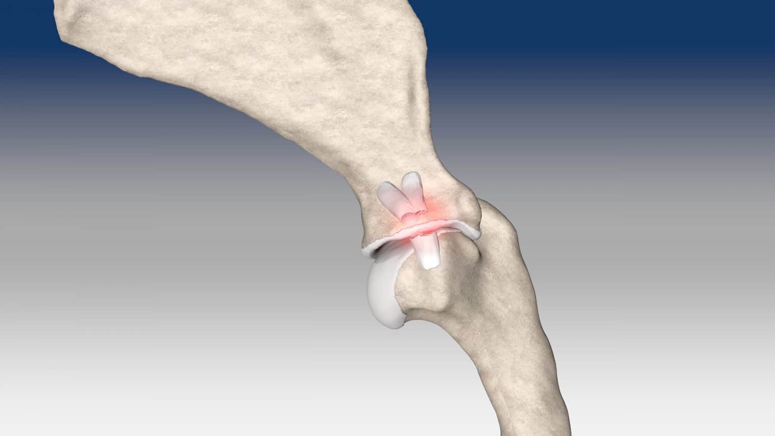 Medial glenohumeral ligament reconstruction