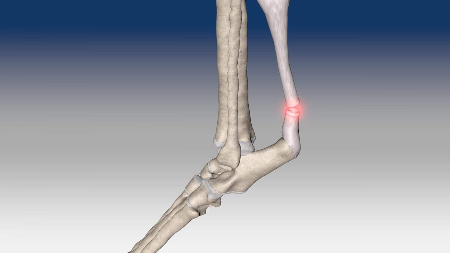 Achilles Tendon Repair