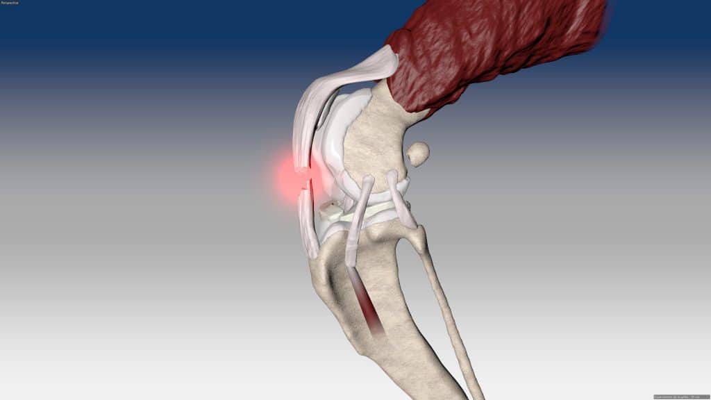 Patellar tendon reconstruction