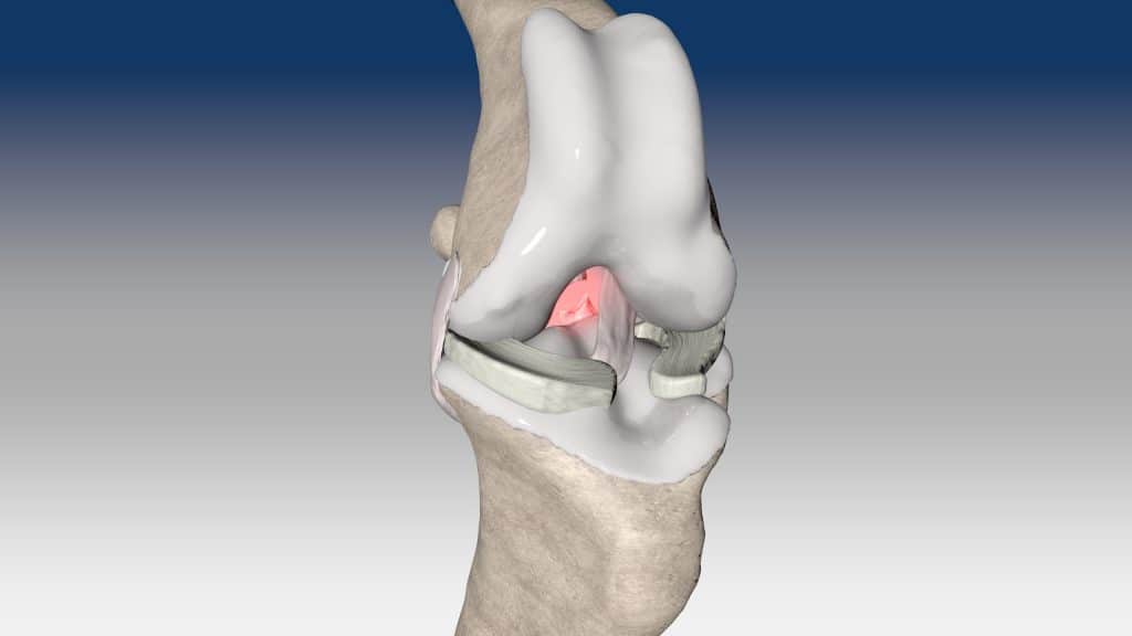 Intra-articular reconstruction of caudal cruciate ligament