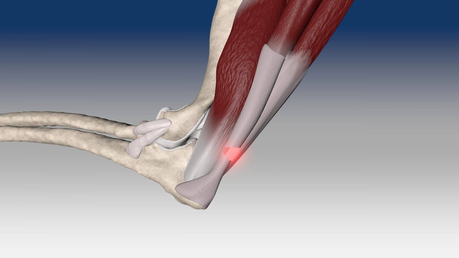 Triceps Tendon Repair