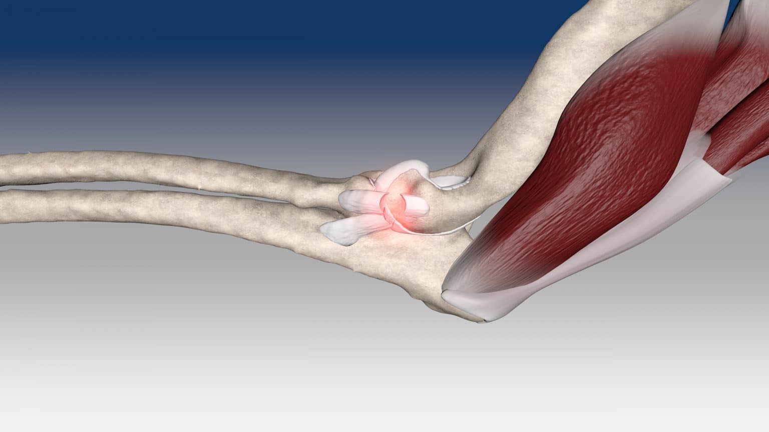 Stabilization of elbow dislocation