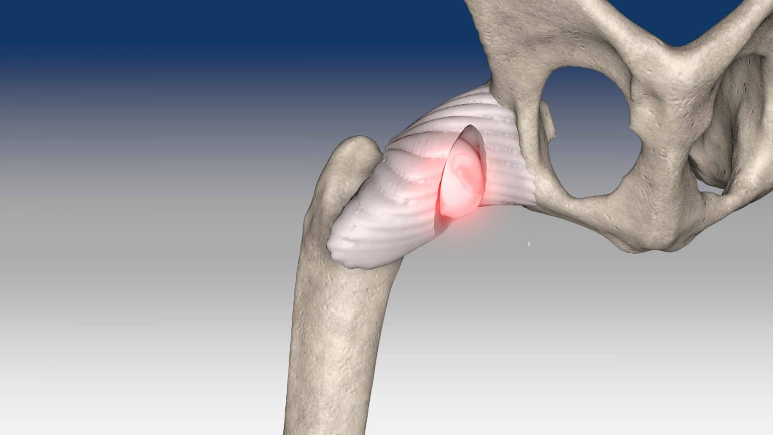 Extra-articular stabilization of caudo-ventral hip dislocation