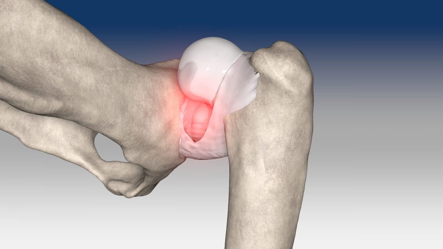 Extra-articular stabilization of craniodorsal hip dislocation